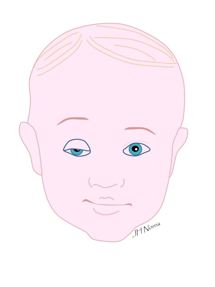 Droopy eyelid (ptosis) - brow suspension - Jonathan Norris