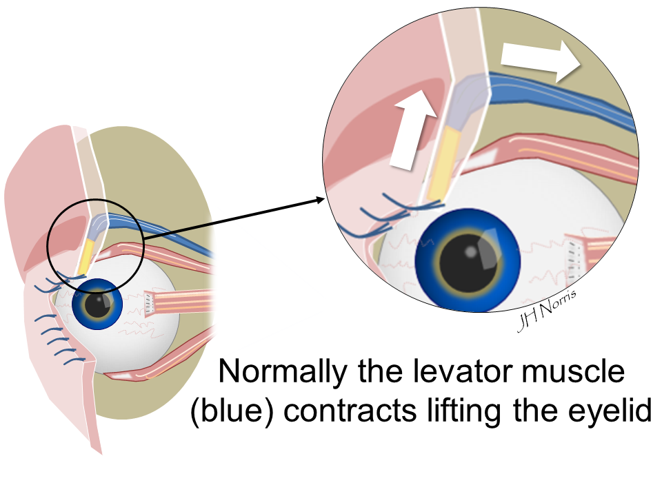 can eye drops help ptosis