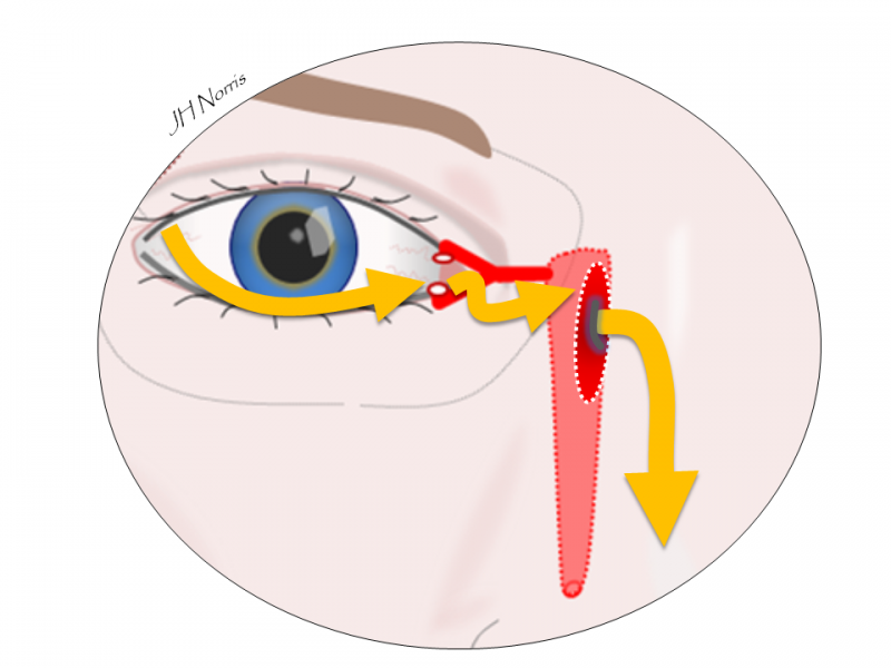 DCR (watery eye) surgery Jonathan Norris