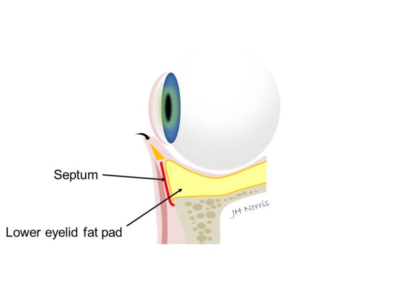 'Eye bag' surgery (lower eyelid blepharoplasty) Jonathan Norris