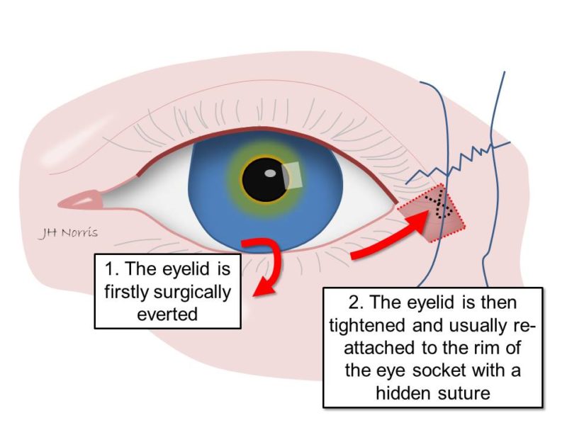 Ectropion Jonathan Norris
